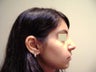 Rhinoplasty