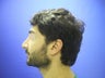 Rhinoplasty