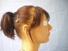 Rhinoplasty