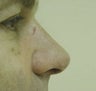 Rhinoplasty