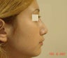 rhinoplasty