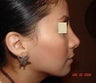 Rhinoplasty