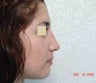Rhinoplasty