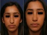Rhinoplasty