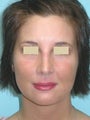 Rhinoplasty