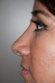 Rhinoplasty