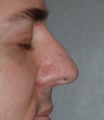 Rhinoplasty - Hump Reduction