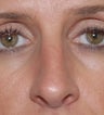 Open Rhinoplasty
