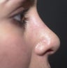 Rhinoplasty