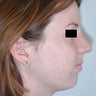 Rhinoplasty
