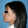 Rhinoplasty