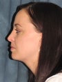 Rhinoplasty