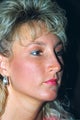 Rhinoplasty