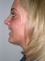 Rhinoplasty
