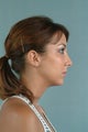 Rhinoplasty