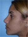 Nose surgery (Rhinoplasty)