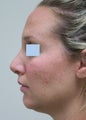 Rhinoplasty