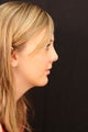 Rhinoplasty