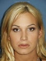 Rhinoplasty with sculpting of nasal tip and nasal dorsum