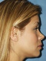 Rhinoplasty