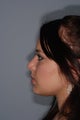 Rhinoplasty