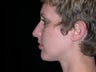 Rhinoplasty and Chin Implants