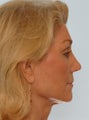 Rhinoplasty
