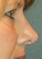 Rhinoplasty