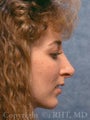 Rhinoplasty