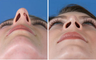 Rhinoplasty