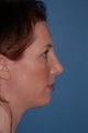 Rhinoplasty