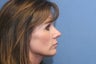 Rhinoplasty