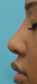 Rhinoplasty