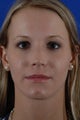 Rhinoplasty