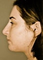 Rhinoplasty
