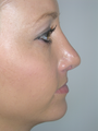 Rhinoplasty