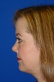 Rhinoplasty