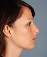 Rhinoplasty