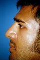 Rhinoplasty