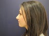Rhinoplasty