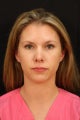 Rhinoplasty