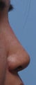 Non Surgical Rhinoplasty