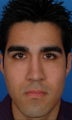 Rhinoplasty