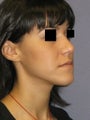 Rhinoplasty