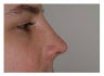 Rhinoplasty