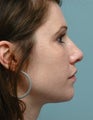 Rhinoplasty