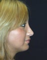 Rhinoplasty
