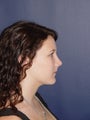 Rhinoplasty