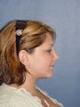 Rhinoplasty, Neck Liposuction & Chin Implant