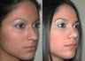 Rhinoplasty